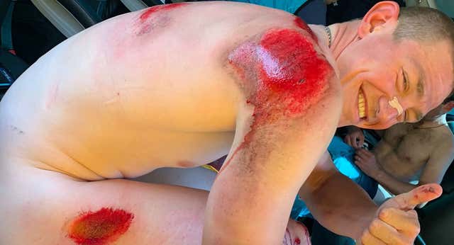 Las magulladuras y la sonrisa de Gleb Syritsa, la imagen más dura del día a día del ciclista