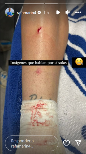 Así quedó la pierna de Rafa Marín.