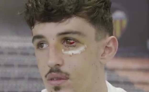 Así estaba el ojo de Diego López hace apenas 15 días.  Valencia C.F