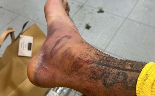 Así estaba el tobillo de Baena hace un año cuando en una situación parecida a la actual se tuvo que infiltrar.  Relevo.